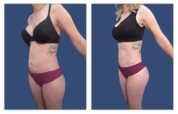 Knowing The Threats Linked To Liposuction surgery post thumbnail image