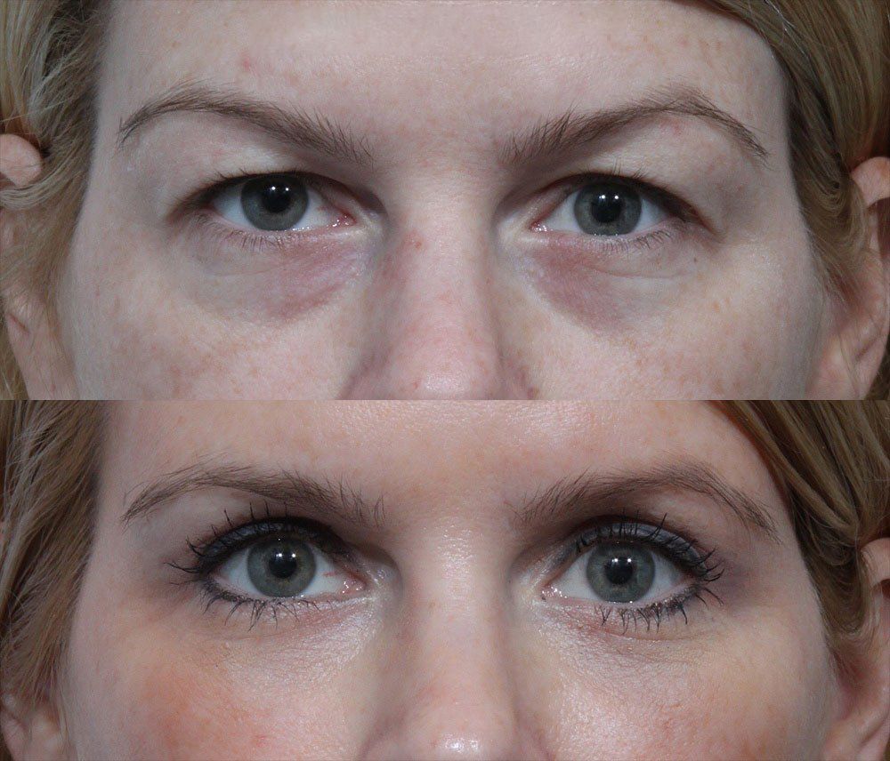 Critical Factors About Eye lid Surgical procedure Santa Barbara That Everybody Should Know post thumbnail image